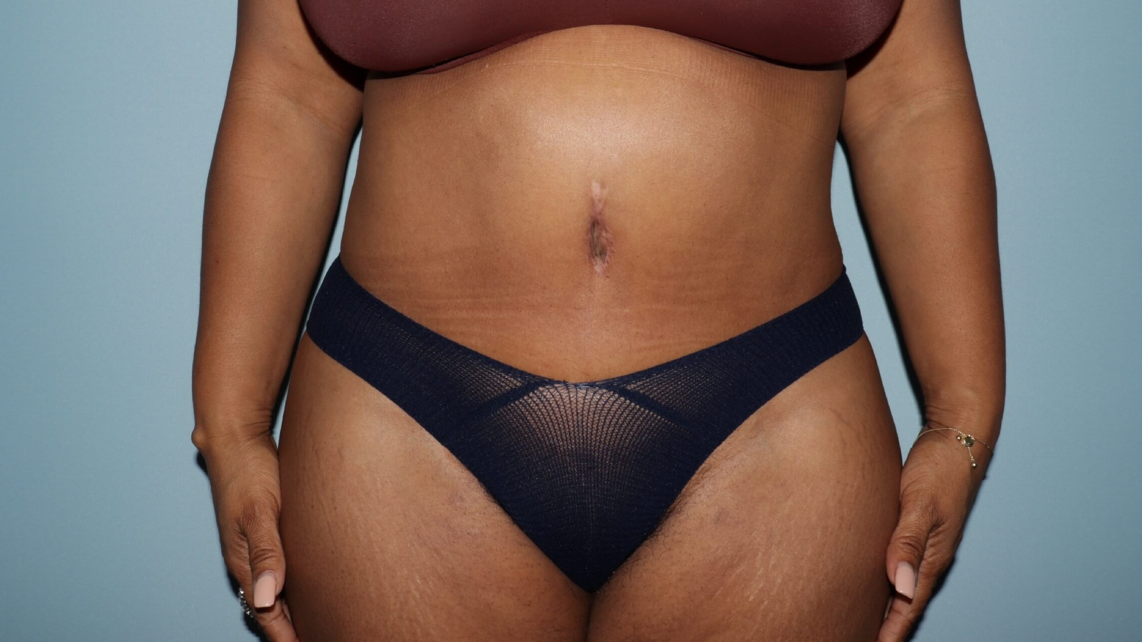 Tummy tuck